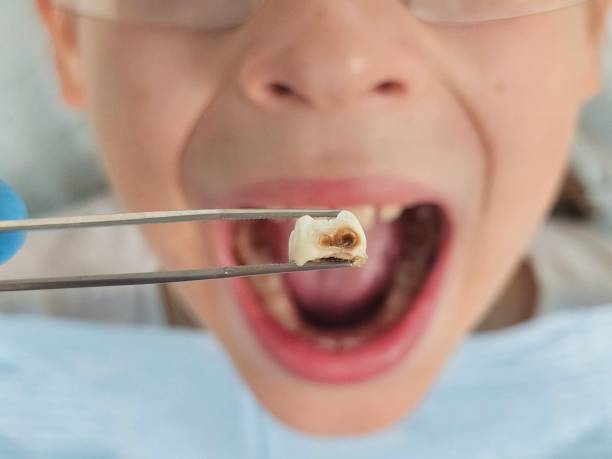 Best Urgent Care for Lost Fillings or Crowns in Lake Cassidy, WA